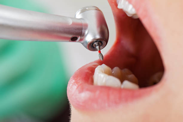 Best Emergency Wisdom Teeth Removal in Indio, CA
